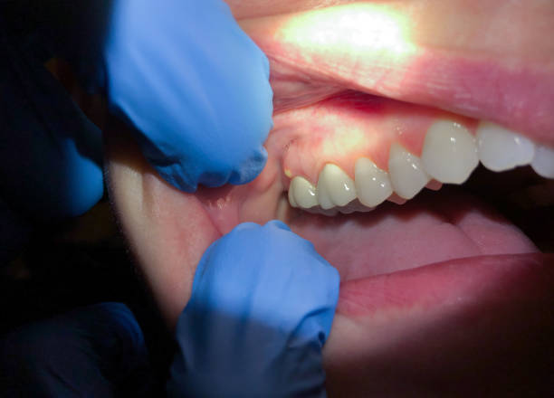 Emergency Care for Swollen Gums