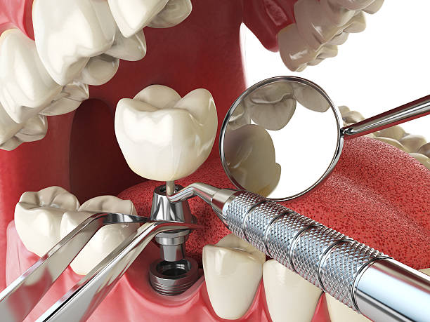 Best Knocked-Out Tooth (Avulsed Tooth) Treatment in Newfield, NJ